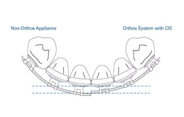 Titanium Orthos™ are Traditional Twin Brackets 